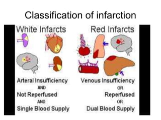 Classification of infarction
 