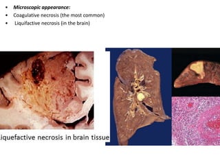 • Microscopic appearance:
• Coagulative necrosis (the most common)
• Liquifactive necrosis (in the brain)
 