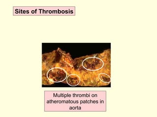 Multiple thrombi on atheromatous patches in aorta Sites of Thrombosis 