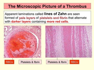 The Microscopic Picture of a Thrombus Apparent laminations called  lines of Zahn  are seen formed of  pale layers  of  platelets and fibrin  that alternate with  darker layers  containing  more red cells . RBCs Platelets & fibrin Platelets & fibrin RBCs 