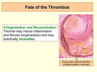Fate of the Thrombus 4.Organization and Recanalization:  Thrombi may induce inflammation and fibrosis (organization) and may eventually  recanalize.  Organization &Recanalization (multiple capillary channels) 