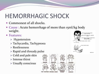 HEMORRHAGIC SHOCK
 Commonest of all shocks.
 Cause : Acute hemorrhage of more than 15ml/kg body
weight.
 Features:
 Hypotension
 Tachycardia, Tachypnoea
 Restlessness
 Rapid and thready pulse
 Cold and pale skin
 Intense thirst
 Usually conscious
 
