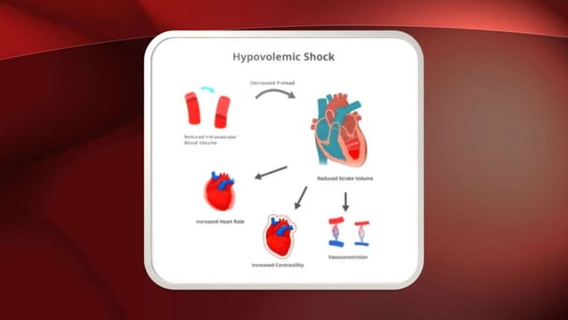 Circulatory shock Cardiogenic Shock Hypovolemic Shock Sepsis, Septic ...