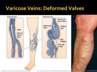 Varicose Veins: Deformed Valves
http://www.varicoseveinguide.com/images/varicoseveins2.jpg http://www.sciencephoto.com/image/263331/530wm/M2900102-Varicose_veins_affecting_the_leg_of_an_elderly_man-SPL.jp
 