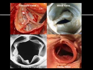 Tricuspid Valve Mitral Valve
Aortic ValveTricuspid Valve
 