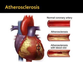 Atherosclerosis
 