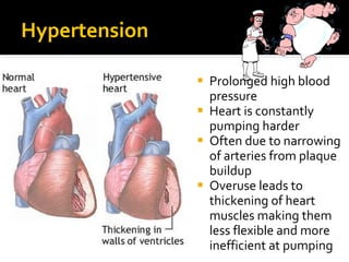 Hypertension
 Prolonged high blood
pressure
 Heart is constantly
pumping harder
 Often due to narrowing
of arteries from plaque
buildup
 Overuse leads to
thickening of heart
muscles making them
less flexible and more
inefficient at pumping
 
