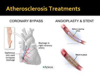 Atherosclerosis Treatments
CORONARY BYPASS ANGIOPLASTY & STENT
 
