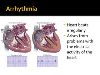 Arrhythmia
 Heart beats
irregularly
 Arises from
problems with
the electrical
activity of the
heart
 
