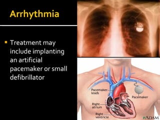 Arrhythmia
 Treatment may
include implanting
an artificial
pacemaker or small
defibrillator
 