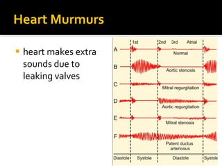 Heart Murmurs
 heart makes extra
sounds due to
leaking valves
 