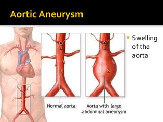 Aortic Aneurysm
 Swelling
of the
aorta
 