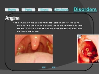 Angina - It is pain or discomfort in the chest which occurs due to a block in the blood vessels leading to the heart. Causes are reduced flow of blood and not enough oxygen.    