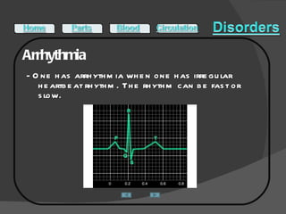 Arrhythmia - One has arrhythmia when one has irregular heartbeat rhythm. The rhythm can be fast or slow.   