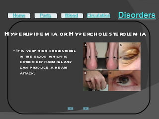 Hyperlipidemia or Hypercholesterolemia  - It is very high cholesterol in the blood which is extremely harmful and can produce a heart attack.  