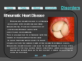 Rheumatic Heart Disease  Rheumatic heart disease is a problem associated with heart damage from  rheumatic flu. It can be diagnosed by a fever and/or rash along with  chest pains or heartburn.  This is usually due to a problem with the  valves in your heart not being able to close properly which leads to blood  spilling out into the wrong parts of the heart. In extreme cases, rheumatic heart disease can lead to heart failure so if you even suspect it (if you notice these symptoms after experiencing rheumatic fever) then go to the doctor’s office or hospital as soon as possible.  