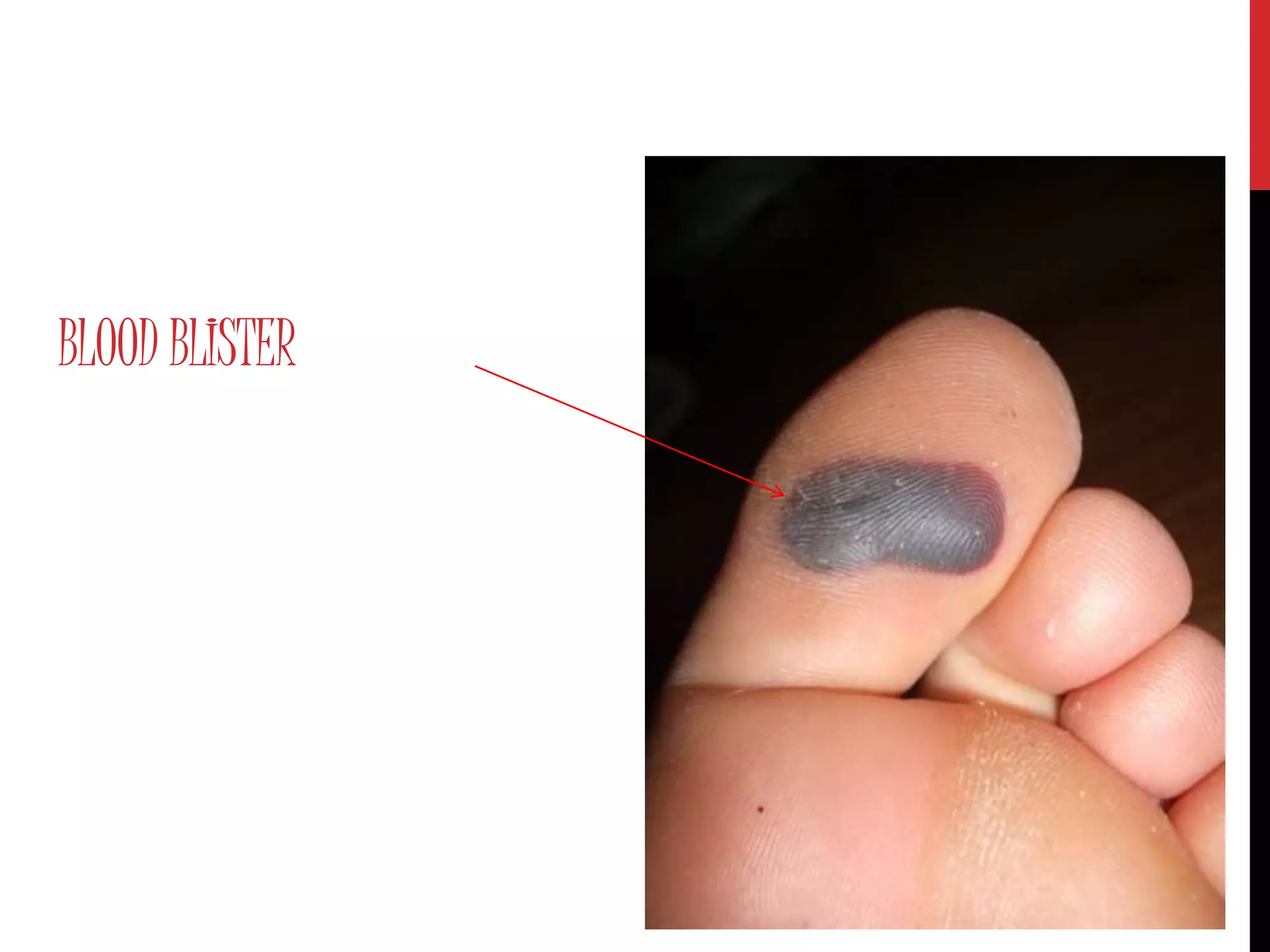 BLOOD BLISTER
 