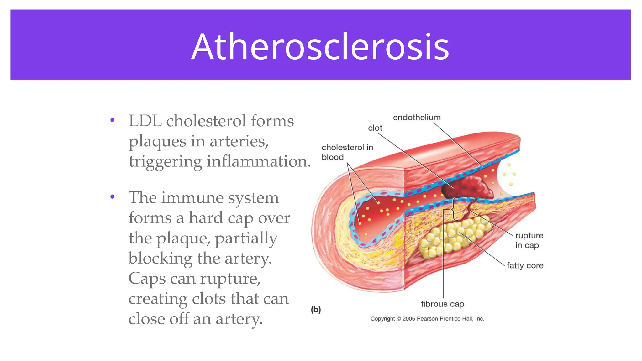Atherosclerosis
• LDL cholesterol forms
plaques in arteries,
triggering inflammation.
• The immune system
forms a hard cap over
the plaque, partially
blocking the artery.
Caps can rupture,
creating clots that can
close off an artery.
 