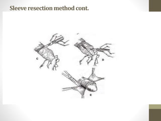 Sleeveresectionmethodcont.
 