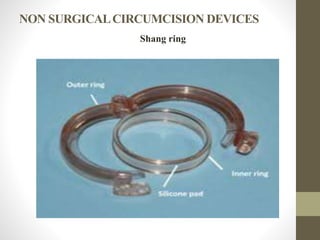 NON SURGICALCIRCUMCISION DEVICES
Shang ring
 