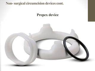 Non- surgical circumcision devices cont.
Prepex device
 