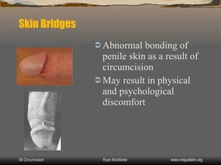 Skin Bridge Excision Circumcision | PPT
