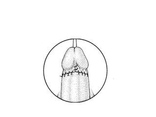 Circumcision | PPTX