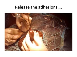 Release the adhesions….
 