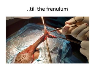 ..till the frenulum
 