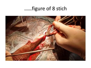 ……figure of 8 stich
 