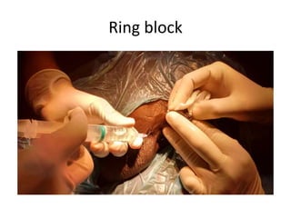Ring block
 