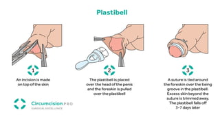 Circumincession Process AN OVERVIEW OF CIRCUMCISION AND VARIOUS TYPES | PPTX