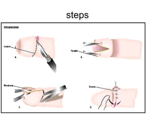 Circumincession Process Circumscision | PPT