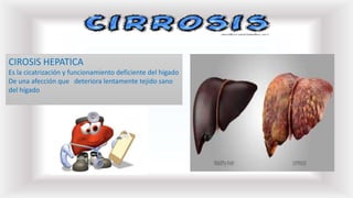 CIROSIS HEPATICA
Es la cicatrización y funcionamiento deficiente del hígado
De una afección que deteriora lentamente tejido sano
del hígado
 