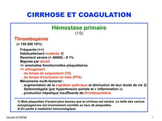 CIRRHOSE ET COAGULATION
Hémostase primaire
(1/2)
Thrombopénie
(< 150 000 109/L)
 
Fréquente (++)
Habituellement modérée 1)...