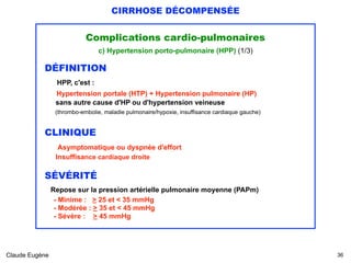 CIRRHOSE DÉCOMPENSÉE
Complications cardio-pulmonaires
c) Hypertension porto-pulmonaire (HPP) (1/3)
DÉFINITION 
HPP, c'est : 
Hypertension portale (HTP) + Hypertension pulmonaire (HP) 
sans autre cause d'HP ou d'hypertension veineuse 
(thrombo-embolie, maladie pulmonaire/hypoxie, insuffisance cardiaque gauche)
CLINIQUE
Asymptomatique ou dyspnée d'effort 
Insuffisance cardiaque droite
SÉVÉRITÉ 
Repose sur la pression artérielle pulmonaire moyenne (PAPm) 
- Minime : > 25 et < 35 mmHg 
- Modérée : > 35 et < 45 mmHg 
- Sévère : > 45 mmHg 
Claude Eugène !36
 