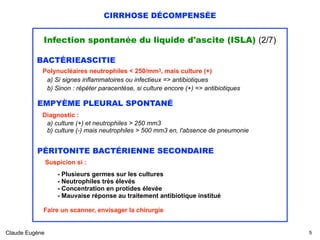 CIRRHOSE DÉCOMPENSÉE
Infection spontanée du liquide d'ascite (ISLA) (2/7)
BACTÉRIEASCITIE
Polynucléaires neutrophiles < 250/mm3, mais culture (+) 
a) Si signes inflammatoires ou infectieux => antibiotiques 
b) Sinon : répéter paracentèse, si culture encore (+) => antibiotiques
EMPYÈME PLEURAL SPONTANÉ
Diagnostic :
a) culture (+) et neutrophiles > 250 mm3 
b) culture (-) mais neutrophiles > 500 mm3 en, l'absence de pneumonie
PÉRITONITE BACTÉRIENNE SECONDAIRE
Suspicion si :
 
- Plusieurs germes sur les cultures 
- Neutrophiles très élevés 
- Concentration en protides élevée
- Mauvaise réponse au traitement antibiotique institué 
Faire un scanner, envisager la chirurgie
Claude Eugène !5
 