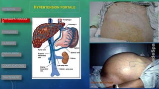 DEFINITION
PHYSIOPATHOLOGI
E
ETIOLOGIES
CLINIQUE
PARACLINIQU
E
COMPLICATIONS
TRAITEMENT
HYPERTENSION PORTALE
 