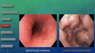 ŒSOPHAGE NORMAL VARICES OESOPHAGIENNES
DEFINITION
PHYSIOPATHOLOGIE
ETIOLOGIES
CLINIQUE
PARACLINIQU
E
COMPLICATIONS
TRAITEMENT
 