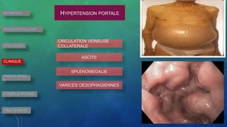 DEFINITION
PHYSIOPATHOLOGIE
ETIOLOGIES
CLINIQUE
PARACLINIQU
E
COMPLICATIONS
TRAITEMENT
HYPERTENSION PORTALE
CIRCULATION VEINEUSE
COLLATERALE
ASCITE
SPLENOMEGALIE
VARICES OESOPHAGIENNES
 