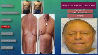 DEFINITION
PHYSIOPATHOLOGIE
ETIOLOGIES
CLINIQUE
PARACLINIQU
E
COMPLICATIONS
TRAITEMENT
INSUFFISANCE HEPATO CELLULAIRE
TROUBLES
ENDOCRINIENS
ICTERE
 