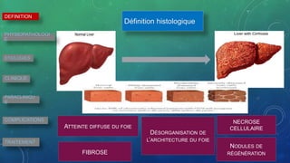 Définition histologique
ATTEINTE DIFFUSE DU FOIE
NODULES DE
RÉGÉNÉRATION
DÉSORGANISATION DE
L’ARCHITECTURE DU FOIE
FIBROSE
NECROSE
CELLULAIRE
DEFINITION
PHYSIOPATHOLOGI
E
ETIOLOGIES
CLINIQUE
PARACLINIQU
E
COMPLICATIONS
TRAITEMENT
 
