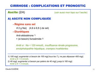 CIRRHOSE : COMPLICATIONS ET PRONOSTIC
Ascite (2/4) (voir aussi mon topo sur l’ascite)
A) ASCITE NON COMPLIQUÉE
- Régime sa...