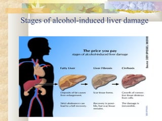Stages of alcohol-induced liver damage
 