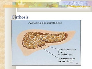 Cirrhosis
 