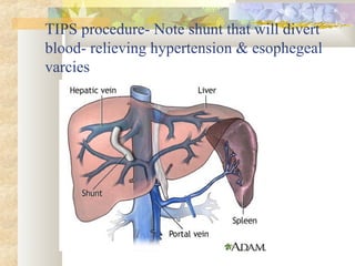 TIPS procedure- Note shunt that will divert
blood- relieving hypertension & esophegeal
varcies
 