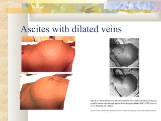 Ascites with dilated veins
 
