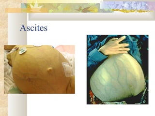 Ascites
 