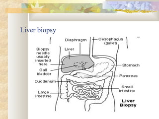 Liver biopsy
 