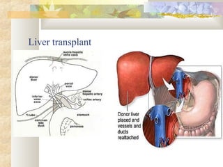 Liver transplant
 